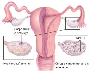 Az inzulinrezisztencia és a meddőség diagnózisa és kezelése