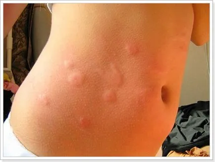 alergii insecte ditey cauze si tratament