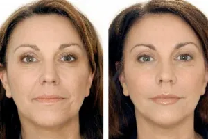 Hogyan lehet megszabadulni a ráncok az arcon és a növekedés a bőr rugalmasságát