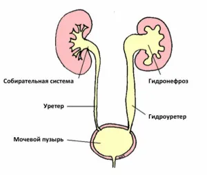 Cum de a vindeca o hidronefroză congenitală de rinichi