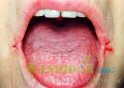 candida cheilitis