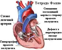 Clasificarea boli congenitale de inimă, sau boală coronariană, defect septal atrial (ASD), un defect