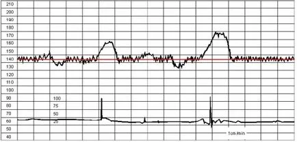 CTG (CTG) на плода, който е и как да се направи това, което трябва и как да се дешифрира CTG