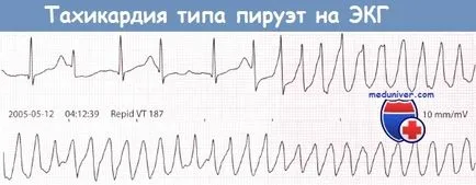 EKG tachycardia piruett típusát és annak kezelése