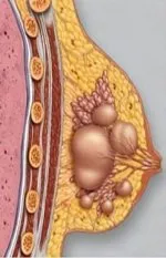 Лекуващите миома и мастит