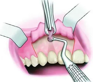 sonde chiuretaje după extracția dentară - interior și chiuretaj