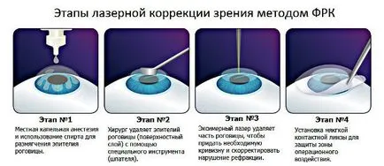 Лечение на корекция на късогледство упражнява с миопия късогледство причини