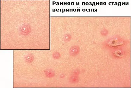 Tratamentul și profilaxia varicella-zoster, varicela tratament