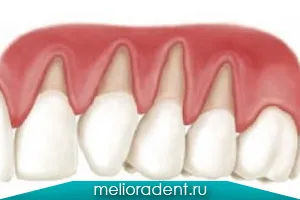 Лечение на венците рецесия в стоматологията, стойност и описание на услугата