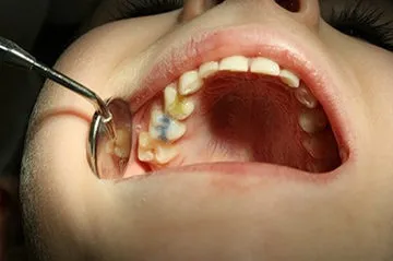 Лечение на пародонтит бебе зъб конкретна процедура