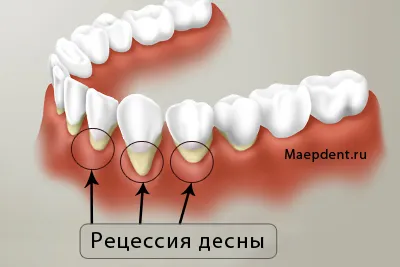 Лечение на венците цена рецесия в Москва