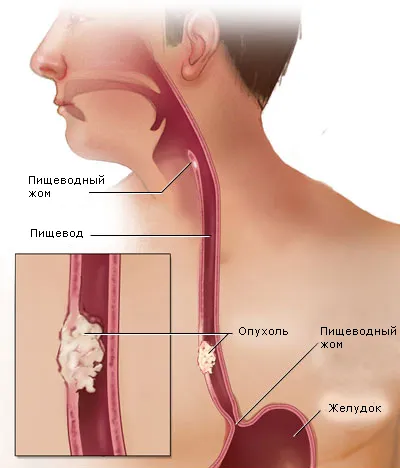 Лейомиома на хранопровода лечение и симптоми на заболяването