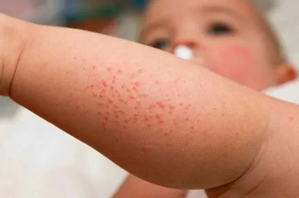 Unguent de alergii la copii instrucțiuni de piele pentru utilizare, preț, recenzii, analogi