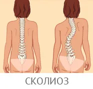 Csigolyaközti osteochondrosis a nyaki gerinc (nyak, üzlet), a kód BNO-10, a videót