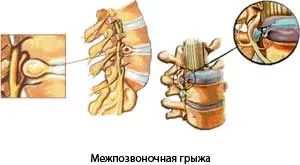 Междупрешленните симптоми и лечение на народната медицина херния