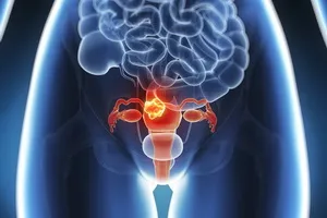 Fibromatoza uterină simptome, semne, diagnostic, tratament conservator al siturilor uterine, chirurgicale si