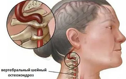 Csigolyaközti osteochondrosis a nyaki gerinc (nyak, üzlet), a kód BNO-10, a videót