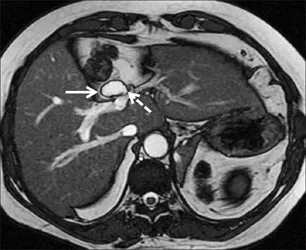 MRI на жлъчния мехур - на цена, четене и подготовката за диагностика