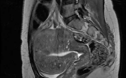 endometrioza RMN, un al doilea aviz