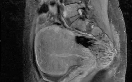 endometrioza RMN, un al doilea aviz