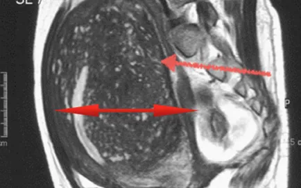 MRI endometriosis, egy második véleményt