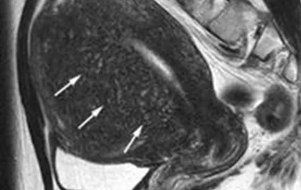 endometrioza RMN, un al doilea aviz