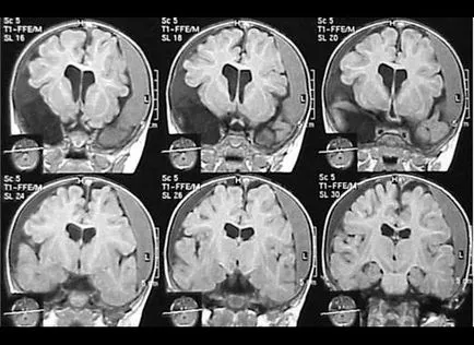 MRI javallatok és ellenjavallatok számára - a gerinc és az agy (abszolút és