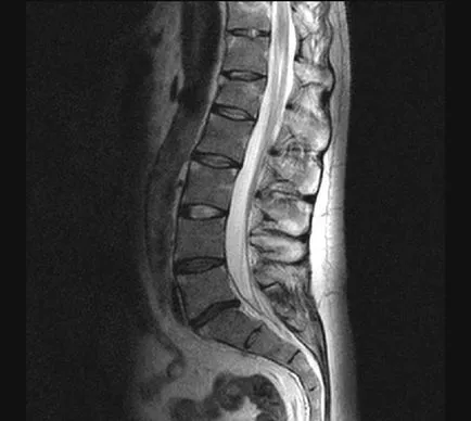 MRI на гръбначния стълб, в центъра на Dikulja