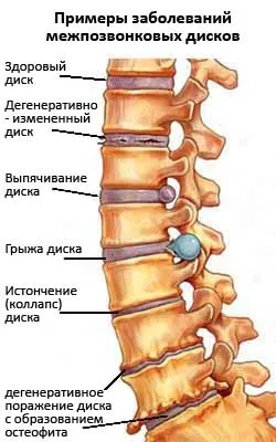 Tratamentul Oamenii de o hernie de disc