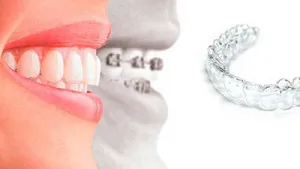 Евтини aligners за коригиране на зъби, ортодонтско лечение прозрачен капа