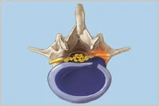 chirurgie a coloanei vertebrale endoscopica, medeor