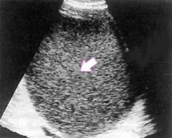 chist endometrioid