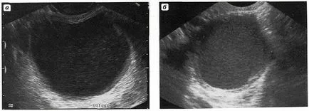 endometrioid ciszta