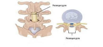 chirurgie a coloanei vertebrale endoscopica, medeor