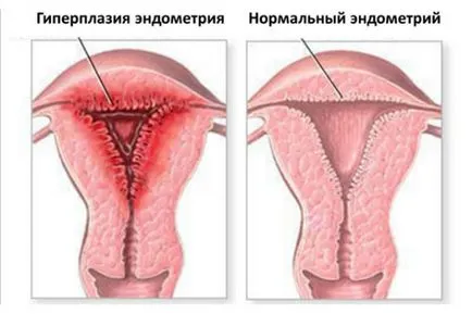 Ендометриума по време на менопаузата скоростта на т-ехо матката