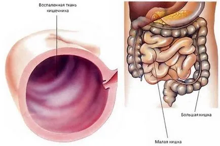 Enterocolitis okok, tünetek, tünetei és kezelése