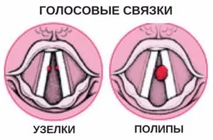 Операцията на гласните струни, за да се промени, за подобряване на глас възстановяване