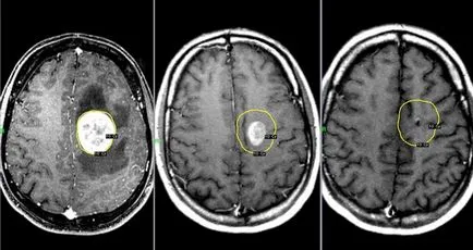 Tumorile cerebrale - clasificarea în funcție de tipul histologic, de Smirnov, localizare