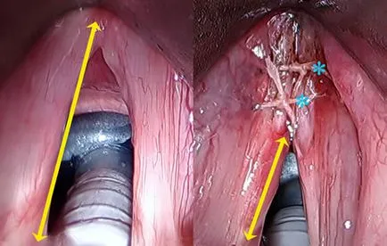 Операцията на гласните струни, за да се промени, за подобряване на глас възстановяване