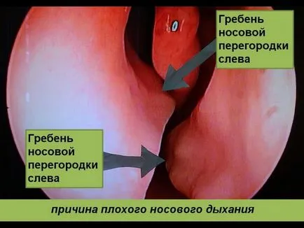 Хирургия за коригиране на носната преграда и показанията на различни методи за изпълнение