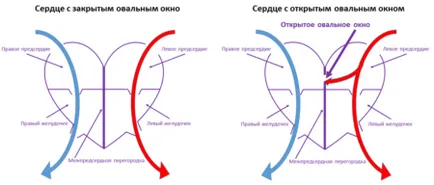 Форамен овале в сърцето на едно дете