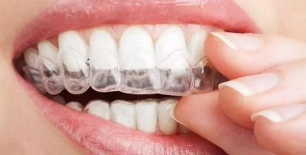 Ортодонтски aligners aligners (Invisalign), невидими шини, онлайн списание