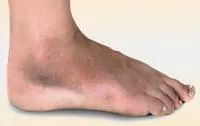 Fractura osului navicular - cauze, simptome și tratament