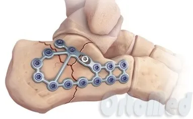 Fractura simptomelor toc, tratament, chirurgie, reabilitare, ipsos în fracturile de calcaneu