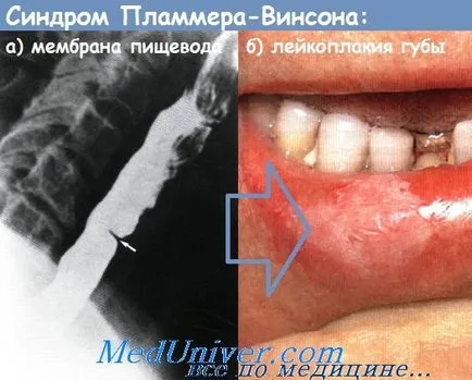 Езофагеален мембрана и пръстенът