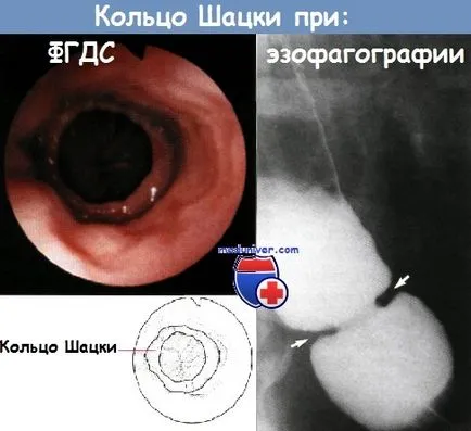 Езофагеален мембрана и пръстенът