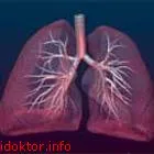 Tüdőgyulladás - az orvos enciklopédia