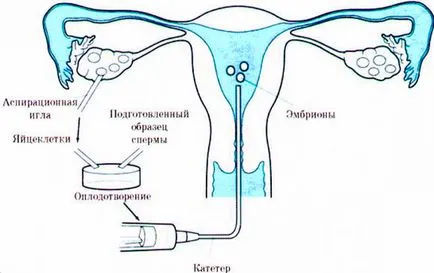 Késői embrió beültetés és HCG IVF