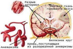 Прогнозата за хеморагичен инсулт - влияещи фактори и мащаба