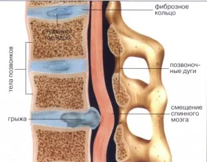 Megelőzése és kezelése porckorongsérv »spine❺